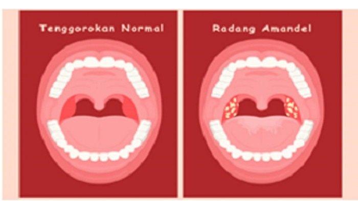 Panduan Lengkap Mengenal Radang Amandel Penyebab Gejala Pengobatan Dan Pencegahan